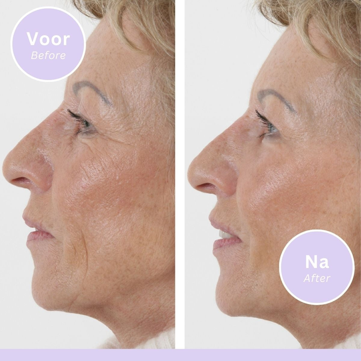 Wrinkle Filler - Anti-Wrinkle Serum - 15 ml - 3 pack