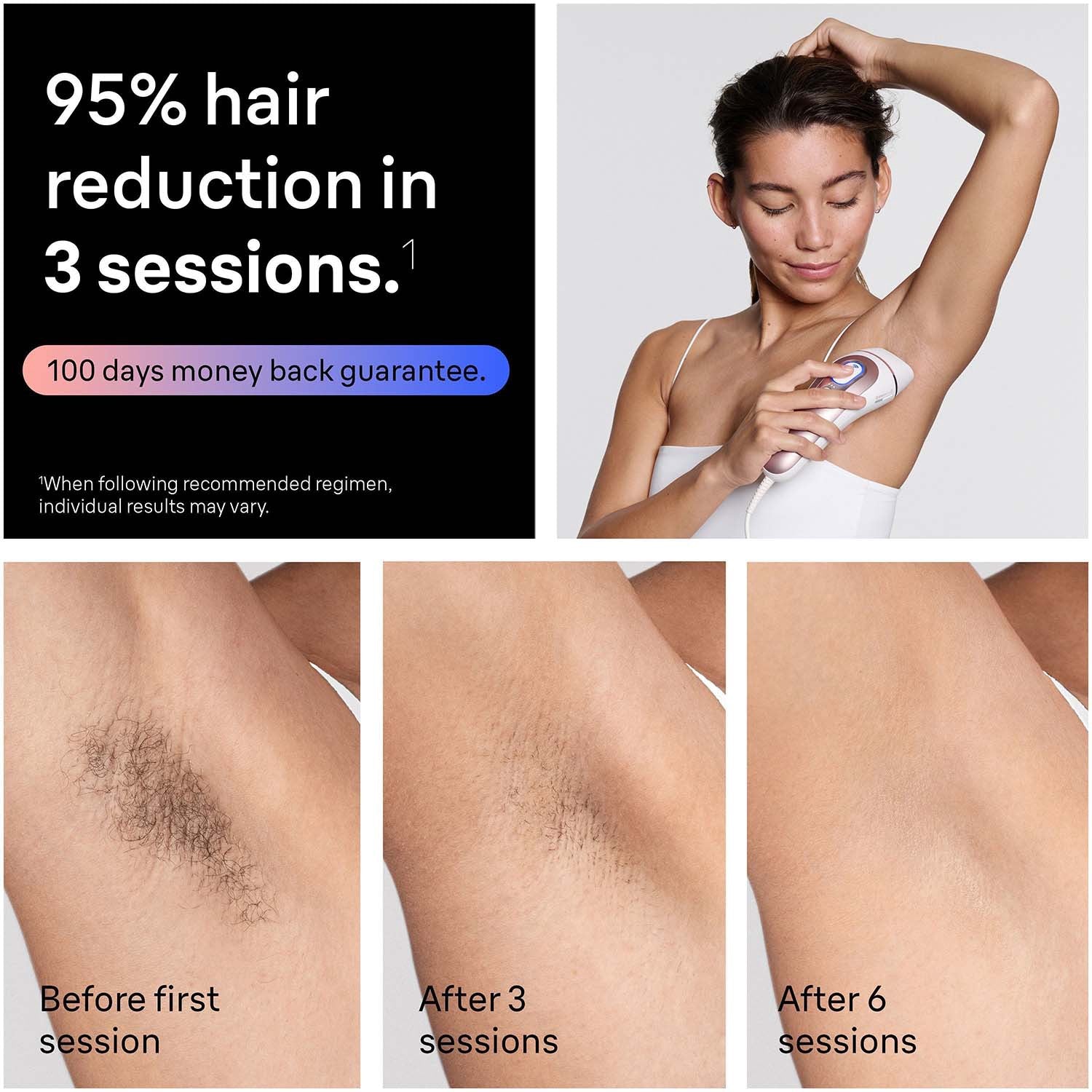 IPL Hair Removal Device, Home Use, Smart Heads, App-Enabled