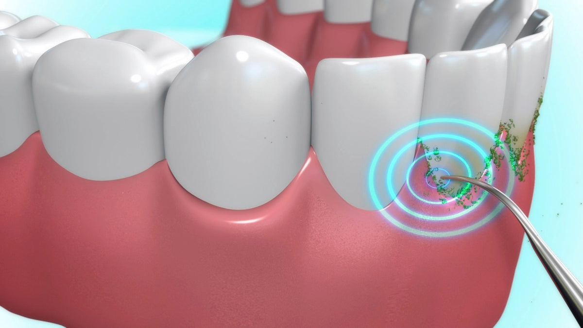 Wireless Dental Flosser with Sonic Vibrations